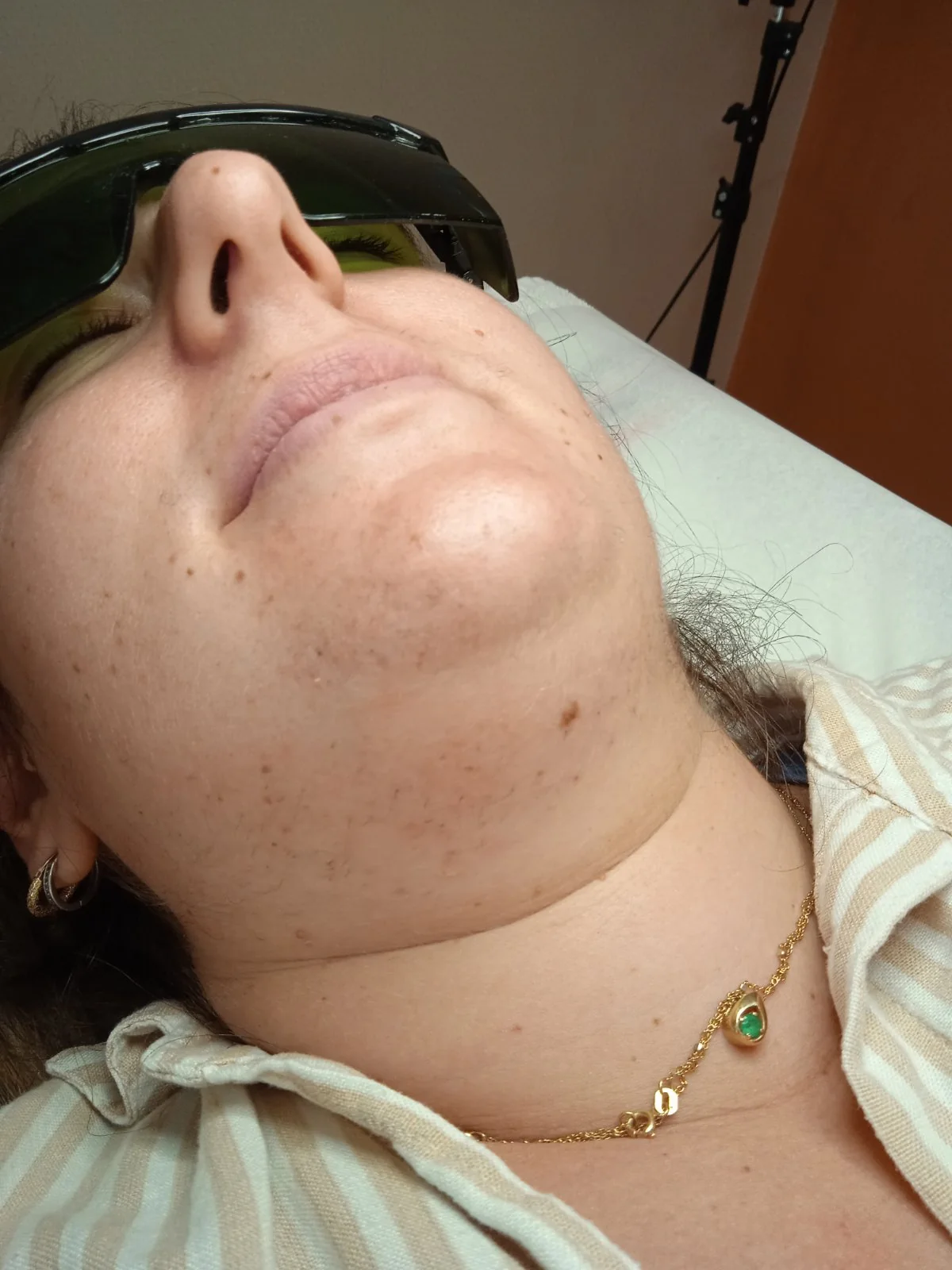 Podbradak i vrat devet meseci nakon početka elektroepilacije, pre tog dana rada: retke tanke dlačice duž vilice i vrata — Salon M Beograd