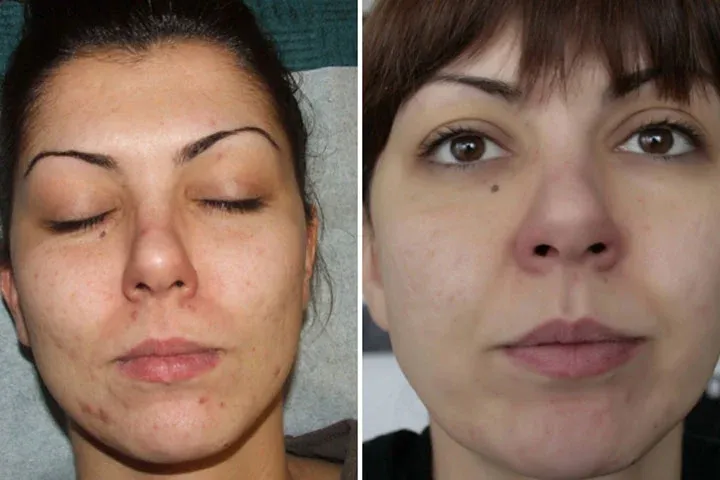 Lice pre i posle tretmana problematične kože
